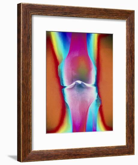 Coloured X-ray of a Human Knee Joint-Mehau Kulyk-Framed Photographic Print