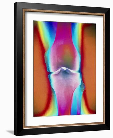 Coloured X-ray of a Human Knee Joint-Mehau Kulyk-Framed Photographic Print