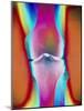 Coloured X-ray of a Human Knee Joint-Mehau Kulyk-Mounted Photographic Print