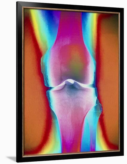 Coloured X-ray of a Human Knee Joint-Mehau Kulyk-Framed Photographic Print