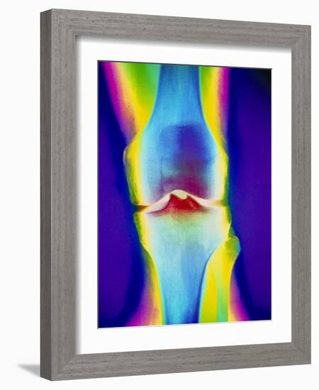 Coloured X-ray of a Human Knee Joint-Mehau Kulyk-Framed Photographic Print