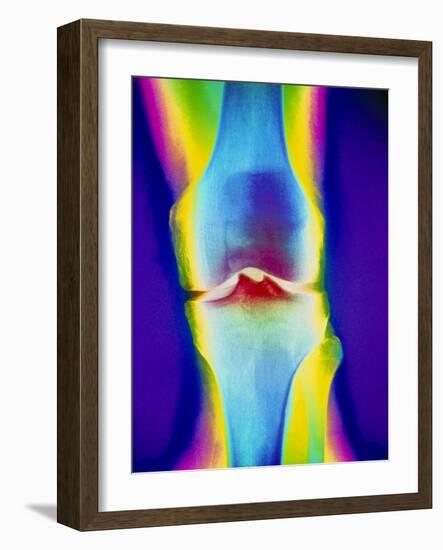 Coloured X-ray of a Human Knee Joint-Mehau Kulyk-Framed Photographic Print