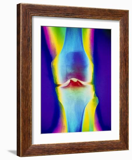 Coloured X-ray of a Human Knee Joint-Mehau Kulyk-Framed Photographic Print