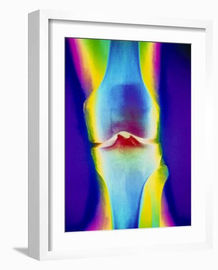 Coloured X-ray of a Human Knee Joint-Mehau Kulyk-Framed Photographic Print