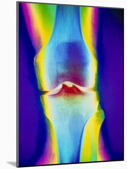 Coloured X-ray of a Human Knee Joint-Mehau Kulyk-Mounted Photographic Print