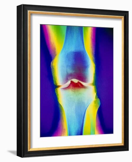 Coloured X-ray of a Human Knee Joint-Mehau Kulyk-Framed Photographic Print