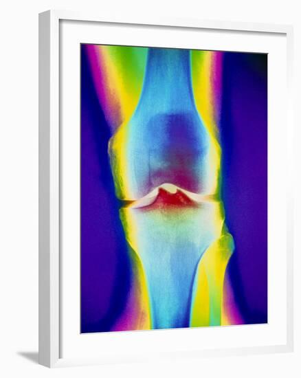 Coloured X-ray of a Human Knee Joint-Mehau Kulyk-Framed Photographic Print