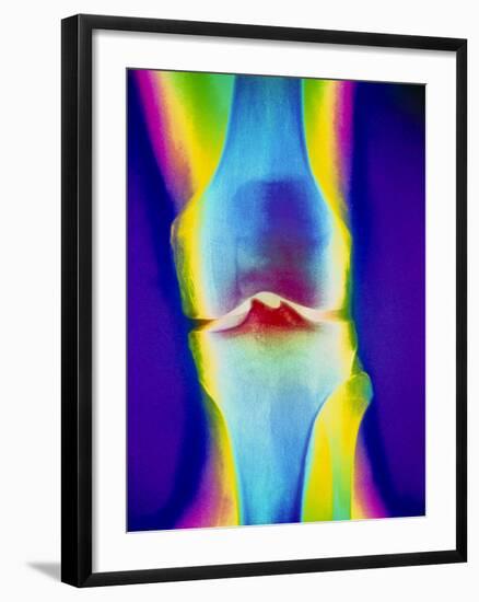 Coloured X-ray of a Human Knee Joint-Mehau Kulyk-Framed Photographic Print