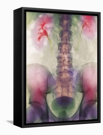 Coloured X-ray of a Kidney Stone In a Ureter-Science Photo Library-Framed Premier Image Canvas