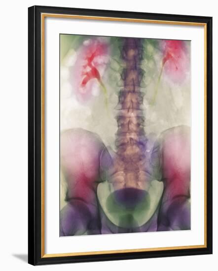 Coloured X-ray of a Kidney Stone In a Ureter-Science Photo Library-Framed Photographic Print