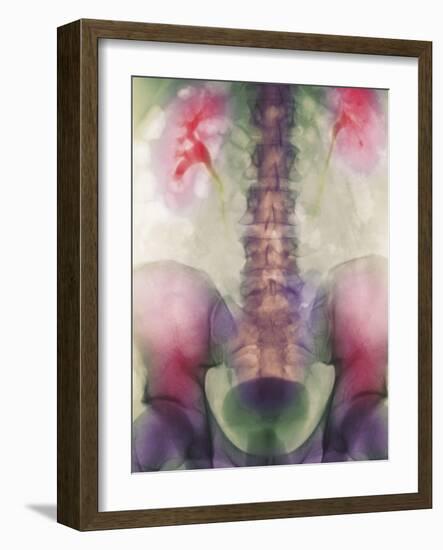 Coloured X-ray of a Kidney Stone In a Ureter-Science Photo Library-Framed Photographic Print