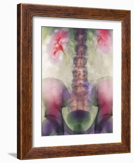 Coloured X-ray of a Kidney Stone In a Ureter-Science Photo Library-Framed Photographic Print