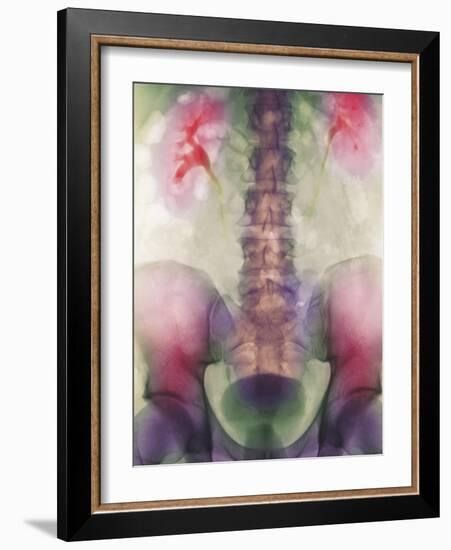 Coloured X-ray of a Kidney Stone In a Ureter-Science Photo Library-Framed Photographic Print