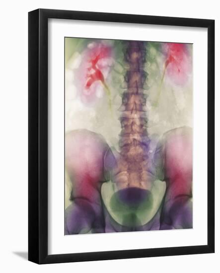 Coloured X-ray of a Kidney Stone In a Ureter-Science Photo Library-Framed Photographic Print
