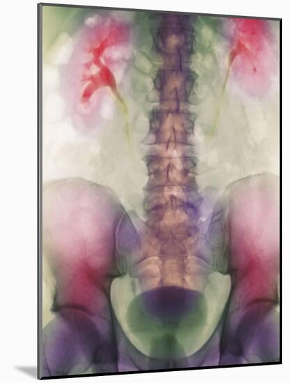 Coloured X-ray of a Kidney Stone In a Ureter-Science Photo Library-Mounted Photographic Print