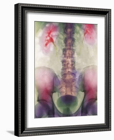 Coloured X-ray of a Kidney Stone In a Ureter-Science Photo Library-Framed Photographic Print