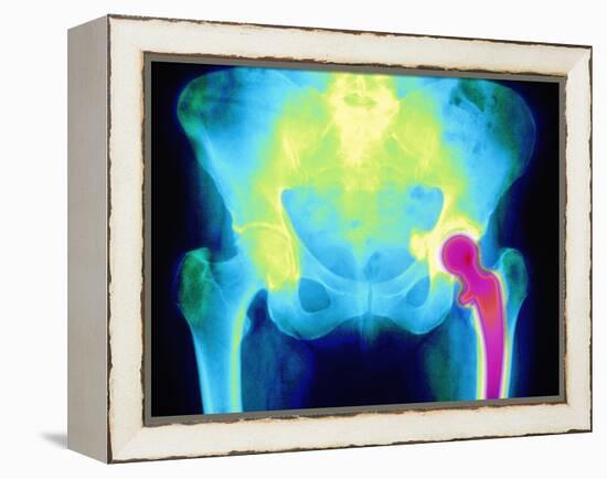 Coloured X-ray of An Artificial Hip Joint-Mehau Kulyk-Framed Premier Image Canvas