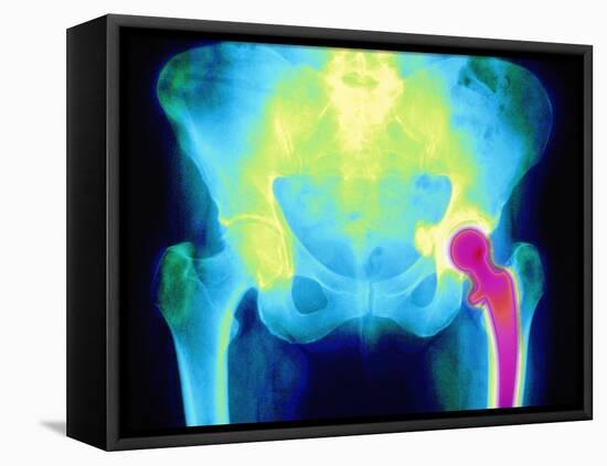 Coloured X-ray of An Artificial Hip Joint-Mehau Kulyk-Framed Premier Image Canvas