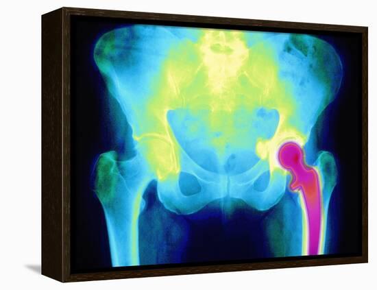 Coloured X-ray of An Artificial Hip Joint-Mehau Kulyk-Framed Premier Image Canvas