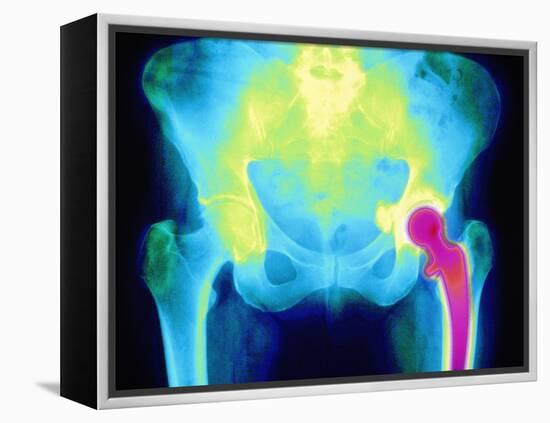 Coloured X-ray of An Artificial Hip Joint-Mehau Kulyk-Framed Premier Image Canvas
