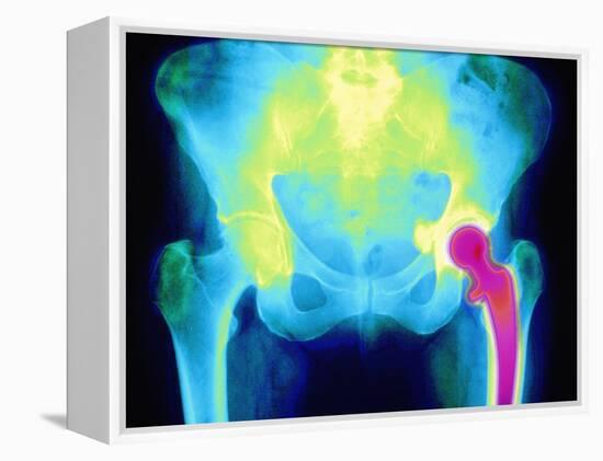 Coloured X-ray of An Artificial Hip Joint-Mehau Kulyk-Framed Premier Image Canvas