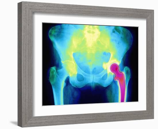 Coloured X-ray of An Artificial Hip Joint-Mehau Kulyk-Framed Photographic Print