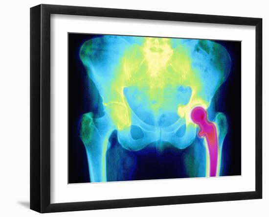 Coloured X-ray of An Artificial Hip Joint-Mehau Kulyk-Framed Photographic Print