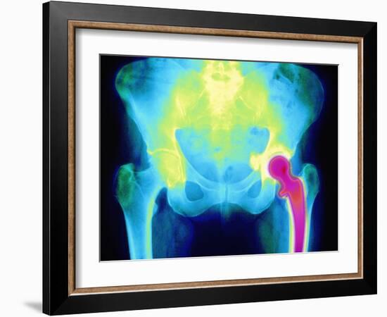 Coloured X-ray of An Artificial Hip Joint-Mehau Kulyk-Framed Photographic Print