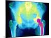 Coloured X-ray of An Artificial Hip Joint-Mehau Kulyk-Mounted Photographic Print