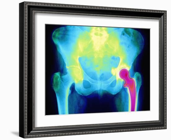 Coloured X-ray of An Artificial Hip Joint-Mehau Kulyk-Framed Photographic Print