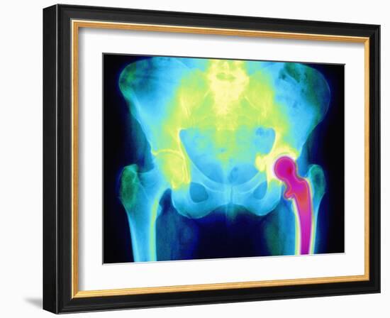 Coloured X-ray of An Artificial Hip Joint-Mehau Kulyk-Framed Photographic Print