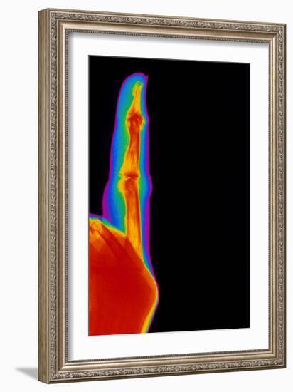 Coloured X-ray of Finger with Rheumatoid Arthritis-Mehau Kulyk-Framed Photographic Print