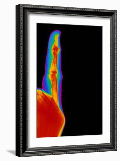 Coloured X-ray of Finger with Rheumatoid Arthritis-Mehau Kulyk-Framed Photographic Print