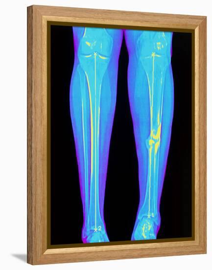 Coloured X-ray of Fractured Shin Bone (tibia)-Mehau Kulyk-Framed Premier Image Canvas