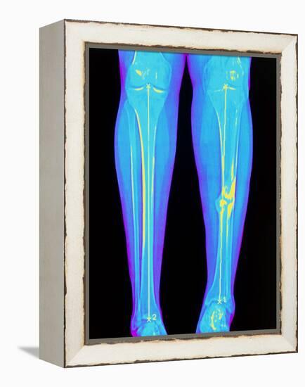 Coloured X-ray of Fractured Shin Bone (tibia)-Mehau Kulyk-Framed Premier Image Canvas