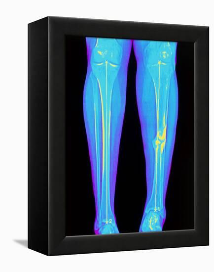 Coloured X-ray of Fractured Shin Bone (tibia)-Mehau Kulyk-Framed Premier Image Canvas