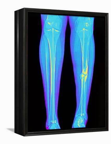 Coloured X-ray of Fractured Shin Bone (tibia)-Mehau Kulyk-Framed Premier Image Canvas