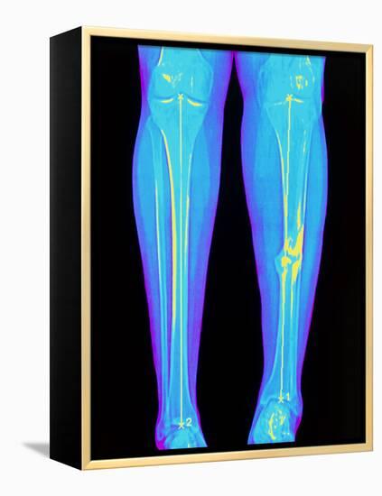 Coloured X-ray of Fractured Shin Bone (tibia)-Mehau Kulyk-Framed Premier Image Canvas