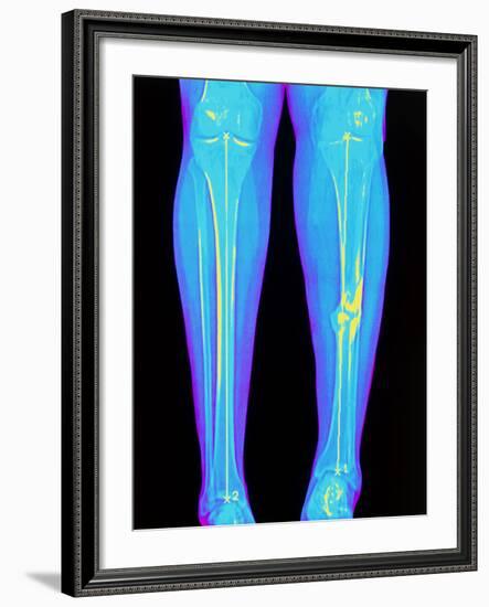 Coloured X-ray of Fractured Shin Bone (tibia)-Mehau Kulyk-Framed Photographic Print