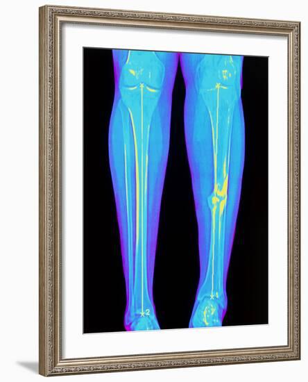 Coloured X-ray of Fractured Shin Bone (tibia)-Mehau Kulyk-Framed Photographic Print