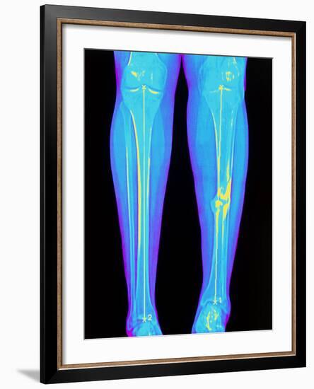 Coloured X-ray of Fractured Shin Bone (tibia)-Mehau Kulyk-Framed Photographic Print