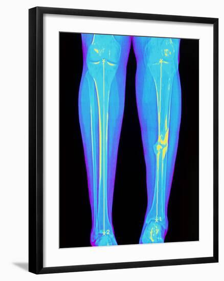 Coloured X-ray of Fractured Shin Bone (tibia)-Mehau Kulyk-Framed Photographic Print