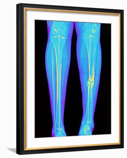 Coloured X-ray of Fractured Shin Bone (tibia)-Mehau Kulyk-Framed Photographic Print