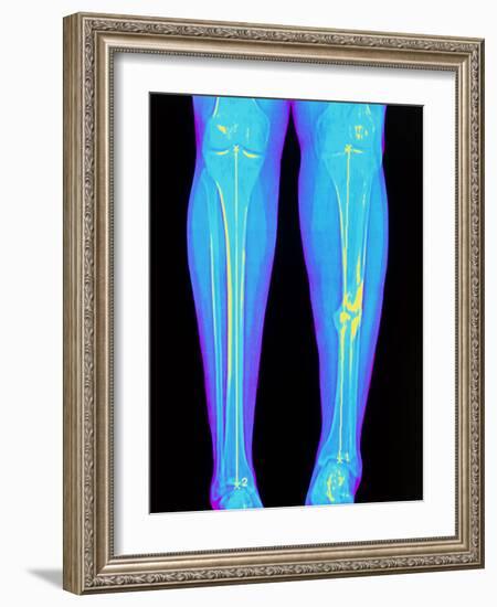 Coloured X-ray of Fractured Shin Bone (tibia)-Mehau Kulyk-Framed Photographic Print