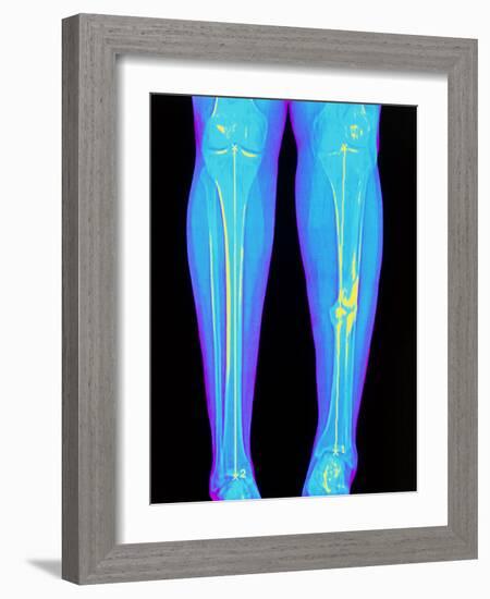 Coloured X-ray of Fractured Shin Bone (tibia)-Mehau Kulyk-Framed Photographic Print