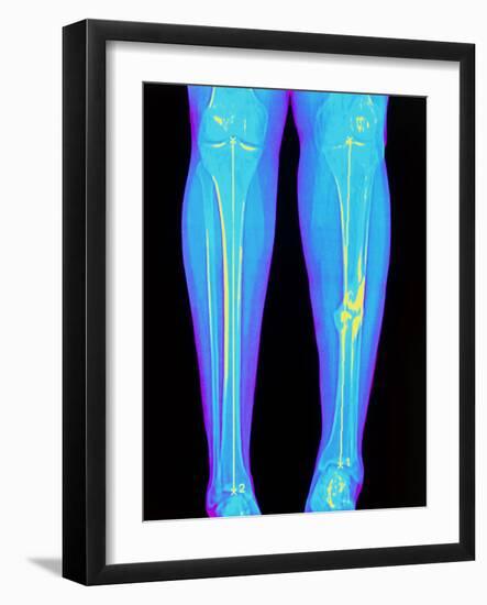 Coloured X-ray of Fractured Shin Bone (tibia)-Mehau Kulyk-Framed Photographic Print