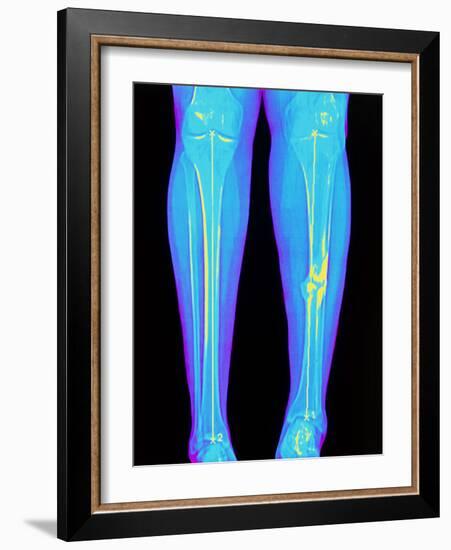 Coloured X-ray of Fractured Shin Bone (tibia)-Mehau Kulyk-Framed Photographic Print