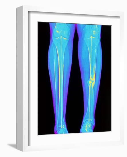 Coloured X-ray of Fractured Shin Bone (tibia)-Mehau Kulyk-Framed Photographic Print