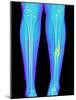 Coloured X-ray of Fractured Shin Bone (tibia)-Mehau Kulyk-Mounted Photographic Print