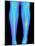 Coloured X-ray of Fractured Shin Bone (tibia)-Mehau Kulyk-Mounted Photographic Print